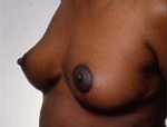 Patient # 25724 After Photo # 4