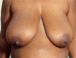 Patient # 25724 Before Photo # 1