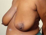 Patient # 25724 Before Photo # 3