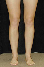 Patient # 86064 After Photo # 4