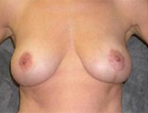 Patient # 37470 After Photo # 2