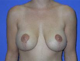 Patient # 62175 After Photo # 2