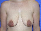 Patient # 62175 Before Photo # 1