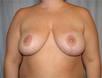 Patient # 48254 After Photo # 2
