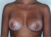 Patient # 35445 After Photo # 2