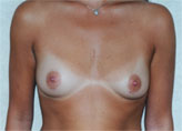 Patient # 35445 Before Photo # 1
