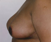 Patient # 79538 After Photo # 4