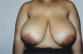 Patient # 79538 Before Photo # 1