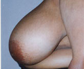 Patient # 79538 Before Photo # 3