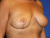 Patient # 37054 After Photo # 4
