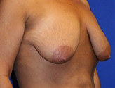 Patient # 37054 Before Photo # 3