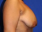 Patient # 37054 Before Photo # 5
