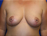 Patient # 36787 After Photo # 2