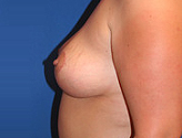 Patient # 36787 After Photo # 6