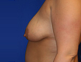 Patient # 36787 Before Photo # 5
