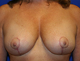 Patient # 74314 After Photo # 2