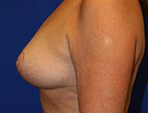 Patient # 74314 After Photo # 6