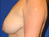 Patient # 74314 Before Photo # 5