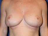 Patient # 16450 After Photo # 2