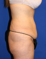 Patient # 97409 Before Photo # 5