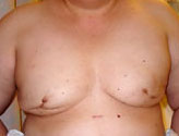 Patient # 61962 Before Photo # 1