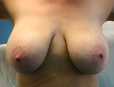 Patient # 15899 Before Photo # 1