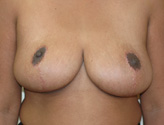 Patient # 98238 After Photo # 2