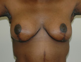 Patient # 47292 After Photo # 2