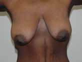 Patient # 47292 Before Photo # 1