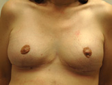 Patient # 36832 After Photo # 2