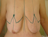 Patient # 36832 Before Photo # 1