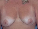 Patient # 16194 Before Photo # 1