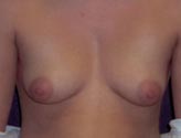 Patient # 45690 Before Photo # 1