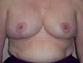 Patient # 94696 After Photo # 2