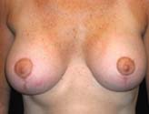 Patient # 39282 After Photo # 2