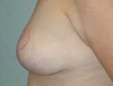 Patient # 75095 After Photo # 4