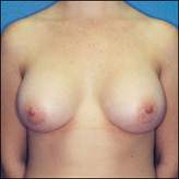 Patient # 41165 After Photo # 2