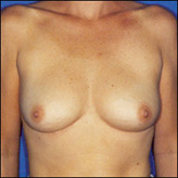 Patient # 48672 Before Photo # 1