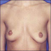 Patient # 22599 Before Photo # 1