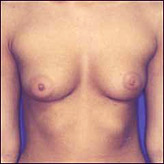 Patient # 27154 Before Photo # 1