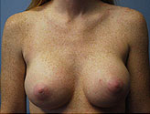 Patient # 66827 After Photo # 2