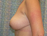 Patient # 53538 After Photo # 4