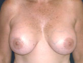 Patient # 50978 After Photo # 2
