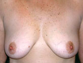 Patient # 50978 Before Photo # 1