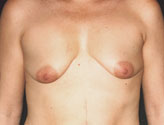 Patient # 26760 Before Photo # 1