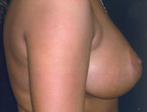 Patient # 74880 After Photo # 4