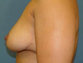Patient # 44475 After Photo # 8