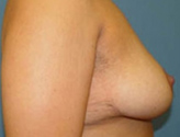 Patient # 44475 After Photo # 10