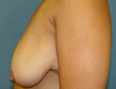 Patient # 44475 Before Photo # 7
