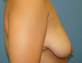 Patient # 44475 Before Photo # 9